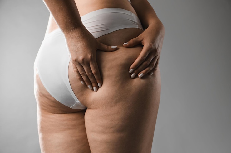 Foto donna con cellulite su sfondo grigio primo piano spazio per il testo