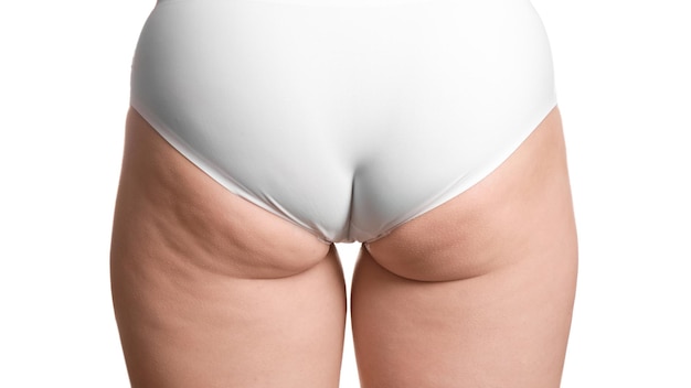Donna con problema di cellulite su sfondo bianco