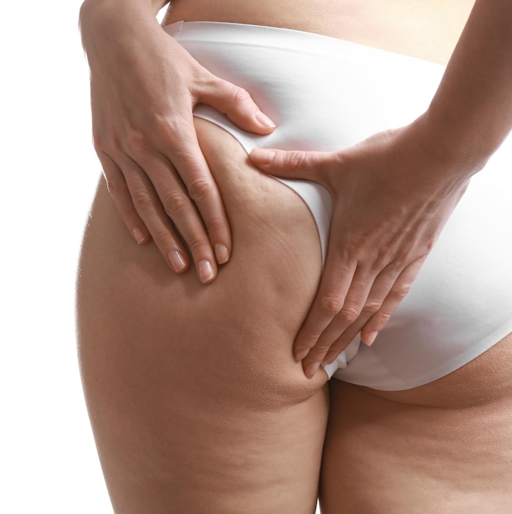 Foto donna con problema di cellulite su sfondo bianco