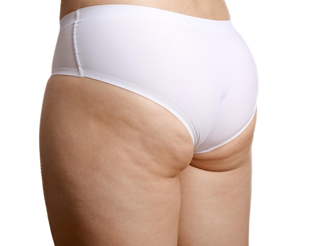 Donna con problema di cellulite su sfondo bianco