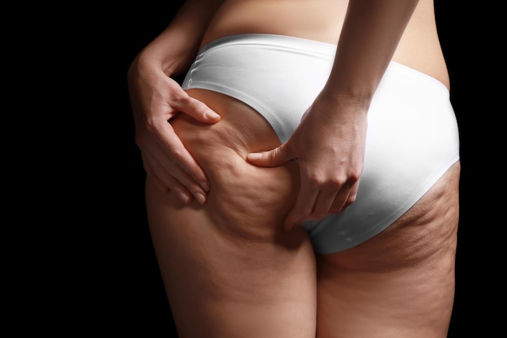 Foto donna con problema di cellulite su sfondo nero