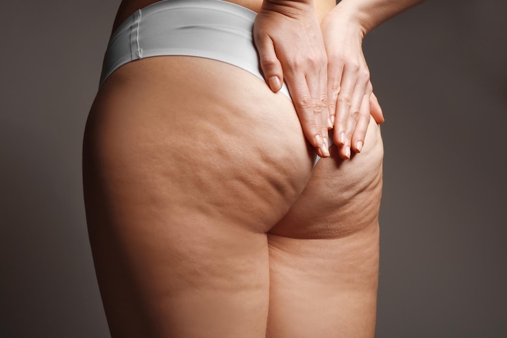 Foto donna con problema di cellulite su sfondo scuro