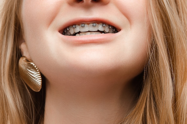 Donna dell'adolescente che sorride con la bocca aperta e che mostra i ganci sui denti