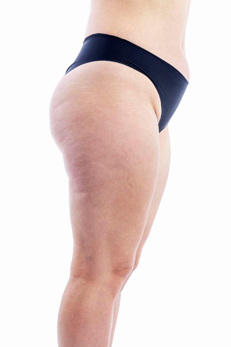 Donna in sovrappeso con cellulite e vene varicose sulle gambe e smagliature sullo stomaco Obesità e malattia Vista laterale Isolato su sfondo bianco Verticale