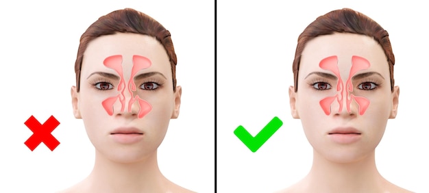 Donna prima e dopo la correzione della deviazione del setto nasale. illustrazione 3D