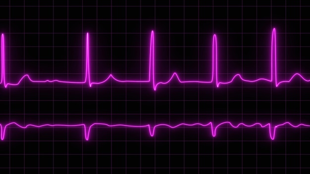 ECG o ECG battito cardiaco di polso simbolo di linea viola su sfondo nero fibrillazione ECG con brevi parossismi di extrasistolia sopraventricolare e fibrillazione atriale al neon