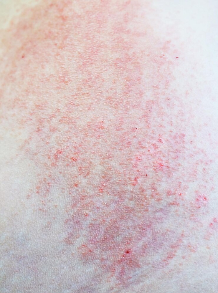 Eruzione cutanea allergica