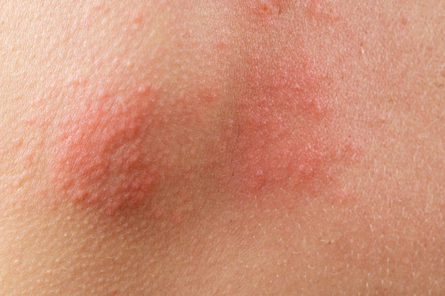 Eruzione cutanea di varicella. Fuoco di Sant'Antonio, virus varicella-zoster. eruzioni cutanee e vesciche sul corpo. Virus dell'herpes zoster infettato dalla pelle. Virus dell'herpes sul corpo. eruzione cutanea di orticaria. dermatite atopica