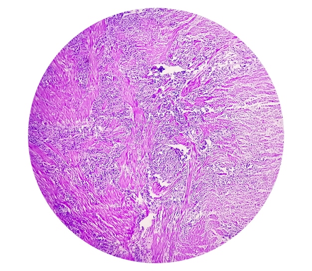 Esame microscopico della cisti del dotto tireoglosso. Dotto tireoglosso persistente