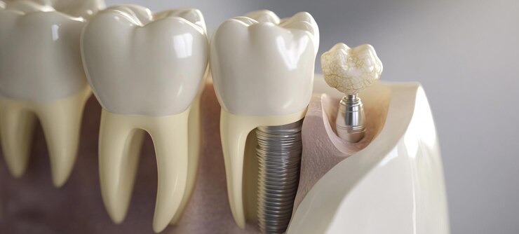 Esplorare le complessità degli impianti dentali una guida completa all'anatomia e al restauro dei denti umani