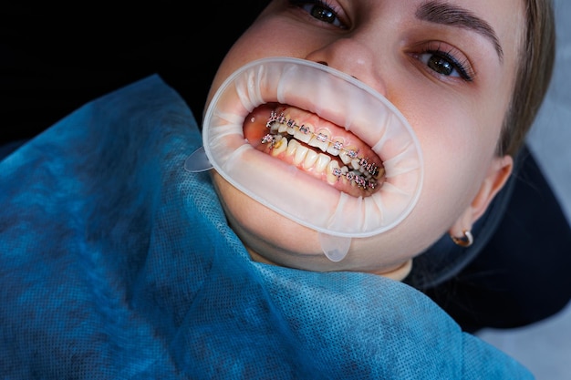 Estensore per denti. Denti di una donna con parentesi graffe ad un appuntamento dal dentista. Trattamento ortodontico della distorsione dei denti. Primo piano, fuoco selettivo. Bretelle sui denti