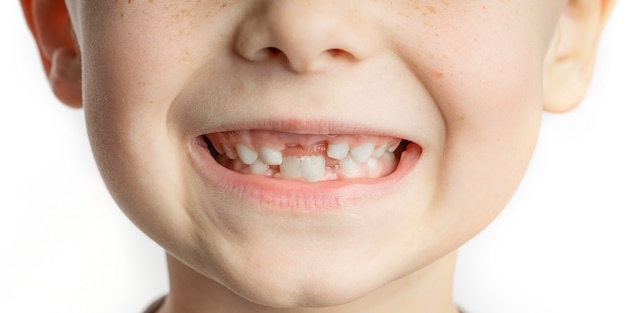 faccia di bambino con denti anteriori persi