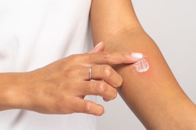Femmina che applica crema sulla pelle gonfia dopo punture di insetti isolate su sfondo grigio per studio allergia