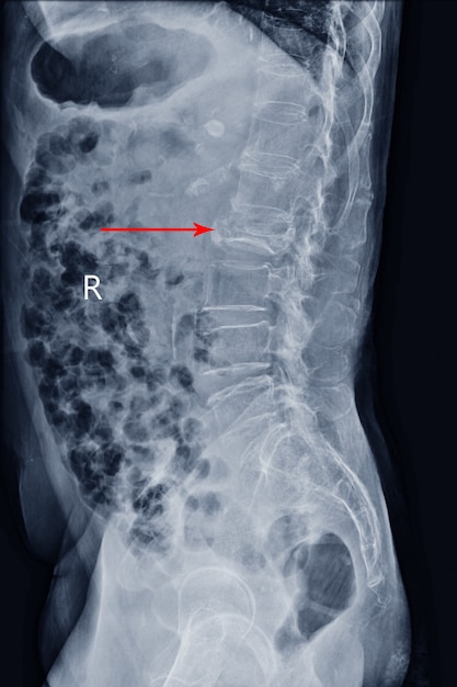 Film X-ray LS-colonna vertebrale Vista laterale che mostra la frattura da scoppio del corpo vertebrale L2 con grave collasso vertebrale, concetto di immagine medica.