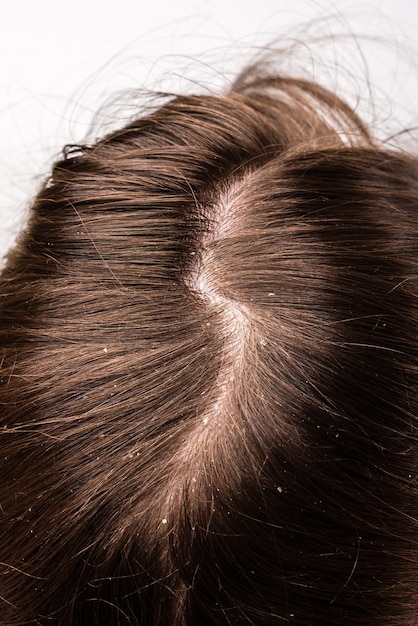 Forfora seborrea problema del cuoio capelluto e trattamento dei capelli del peeling da allergie o licheni.