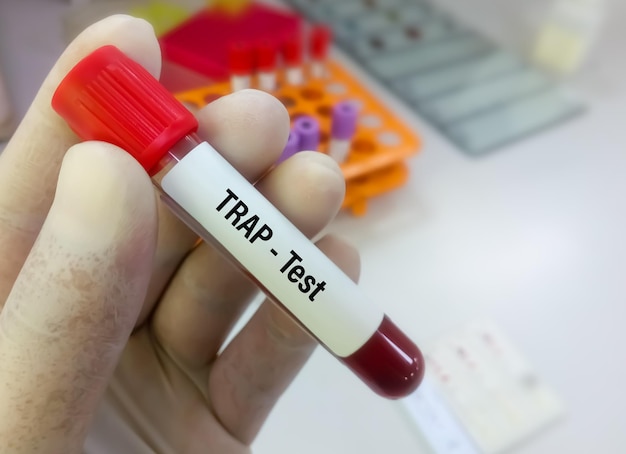 Fosfatasi acida tartrato resistente o test TRAP per la diagnosi della leucemia a cellule capellute