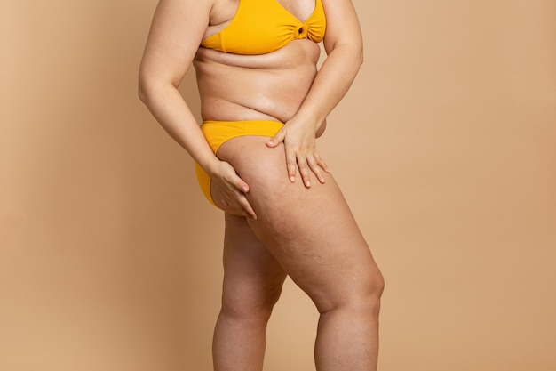 Foto ritagliata della pelle arancione in eccesso del corpo della donna in costume da bagno giallo trattamento della cellulite dell'obesità sui glutei dei fianchi