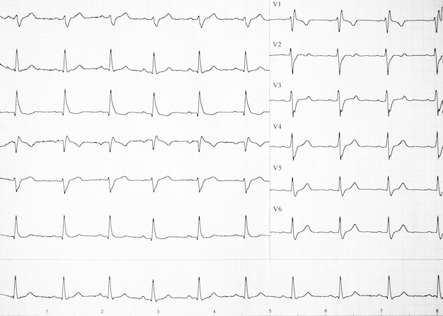 Frequenza cardiaca su carta per la registrazione di un elettrocardiogramma prevenzione delle malattie cardiache elettrocardiogra