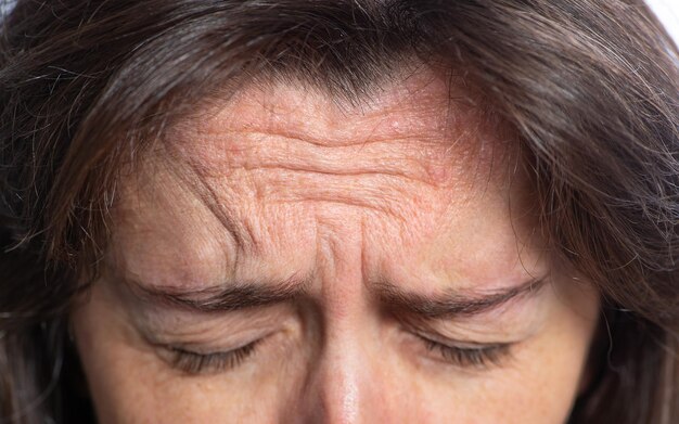 Fronte rugosa della donna che mostra le rughe un concetto di segni di invecchiamento e che ricorre a trattamenti di bellezza per un effetto antietà