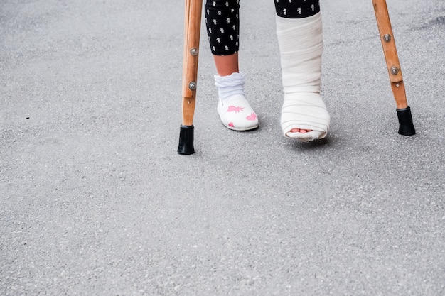 gambe della ragazza in cast ortopedico con le stampelle camminando per la strada