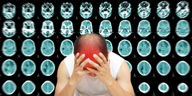 Giornata mondiale dell'ictus CT Scan Brain Un uomo che soffre di dolore pulsante di mal di testa