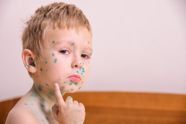 Giovane bambino, ragazzo con varicella. Bambino malato con varicella. Virus della varicella o eruzioni cutanee con bolle di varicella sul corpo e sul viso del bambino.