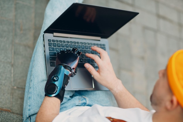 Giovane disabile con mano protesica artificiale utilizzando la digitazione sulla tastiera del computer portatile