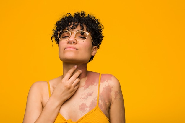 Giovane donna afro-americana con marchio di nascita della pelle soffre di dolore alla gola a causa di un virus o un'infezione.