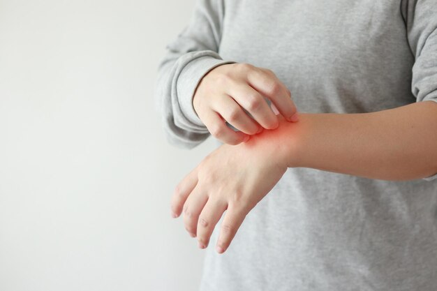 Giovane donna asiatica che prude e gratta il braccio a causa di pelle secca pruritiva, eczema e dermatite.