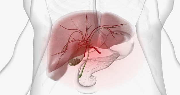 I calcoli biliari sono pezzi di materiale solido che formano nella cistifellea un piccolo organo cavo situato sotto il fegato