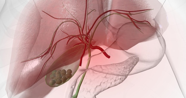 I calcoli biliari sono pezzi di materiale solido che formano nella cistifellea un piccolo organo cavo situato sotto il fegato