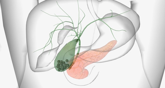 I calcoli biliari sono pezzi di materiale solido che formano nella cistifellea un piccolo organo cavo situato sotto il fegato