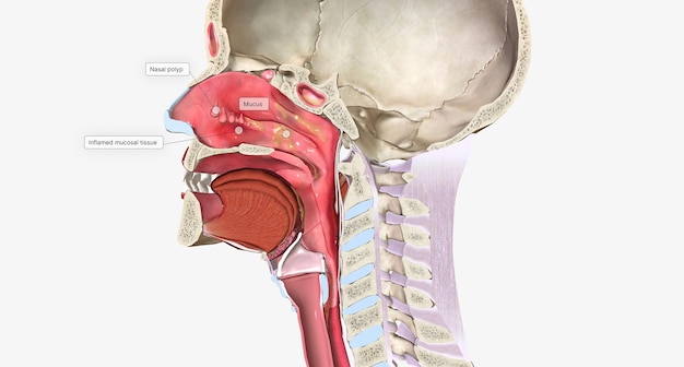 I polipi nasali sono escrescenze molli benigne che derivano dalla mucosa dei passaggi nasali o dei seni