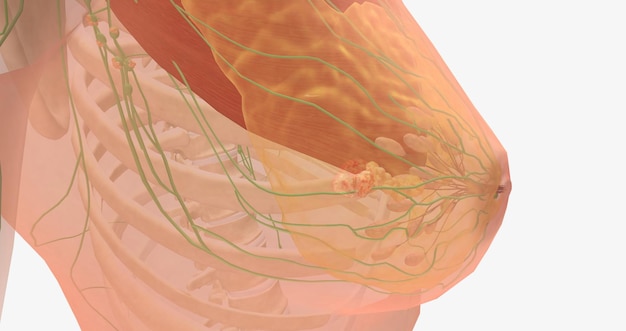I tumori al seno in stadio III sono invasivi e si sono diffusi ai linfonodi intorno alla clavicola o a quelli profondi all'interno del seno