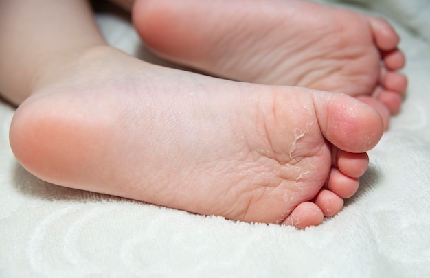 Il bambino graffia la pelle atopica Dermatite diatesi allergia sul corpo del bambino