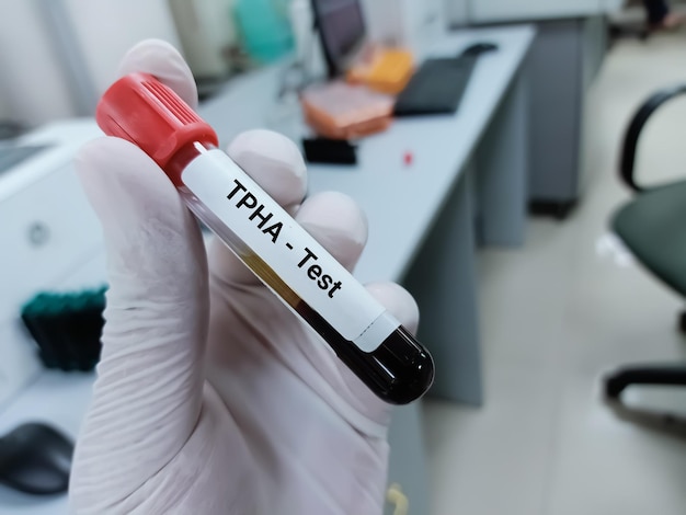 Il biochimico o il medico tiene un campione di sangue per il test TPHA di emoagglutinazione di Treponema pallidum