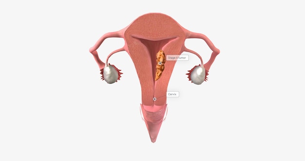 Il carcinoma dell'endometrio in stadio II è caratterizzato dalla diffusione del tumore alla cervice uterina