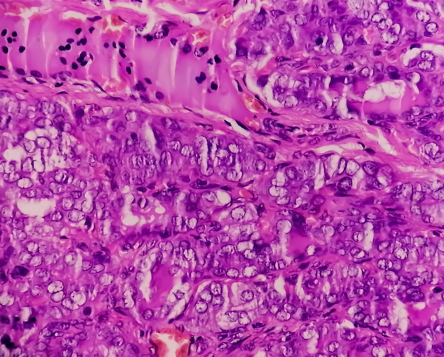 Il carcinoma papillare della tiroide è il tipo più comune di cancro che colpisce la tiroide