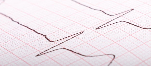 Il cardiogramma Ekg degli impulsi cardiaci chiude il trattamento dell'ipertensione