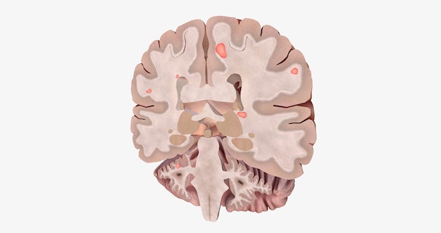 Il cervello con lesioni 3D