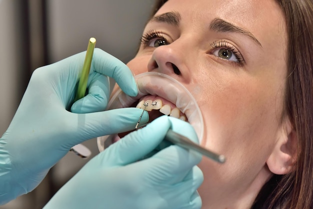 Il dentista esamina i denti con le parentesi graffe