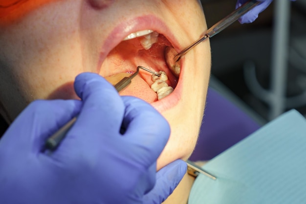 Il dentista esamina il dente del paziente con cavità nera su di esso utilizzando strumenti dentali e specchio Carie dentaria nell'apertura del primo piano della bocca