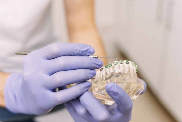 Il dentista mostra un modello artificiale della mascella con le parentesi graffe. Come prendersi cura adeguatamente della cavità orale, mettere parentesi graffe, costi e conseguenze