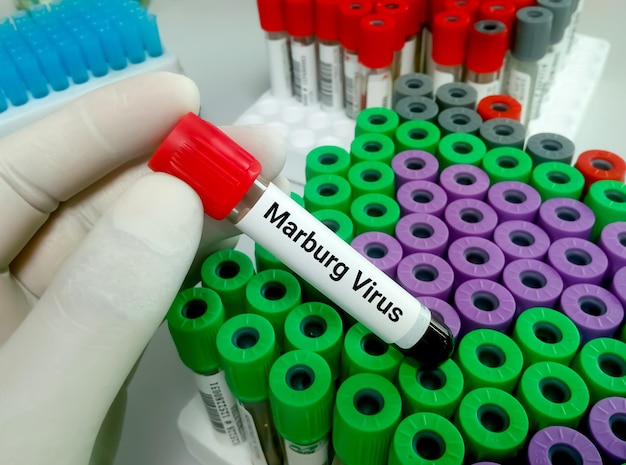 Il medico tiene la provetta con il campione di sangue per il test del virus Marburg