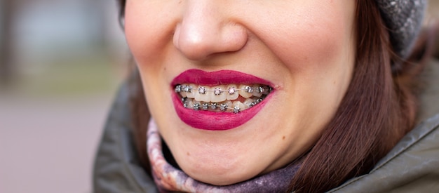 Il sistema del tutore nella bocca sorridente della ragazza, la fotografia macro dei denti, il primo piano delle labbra rosse. Ragazza che cammina per strada