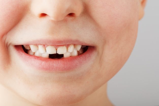 Il sorriso di un bambino senza denti da latte più bassi.