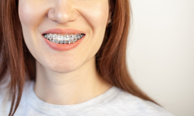 Il sorriso di una giovane ragazza con le parentesi graffe sui denti bianchi. Raddrizzamento dei denti. Malocclusione. Cure odontoiatriche.