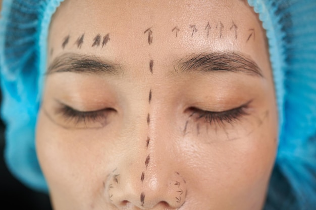 Il viso di una giovane donna asiatica con segni per il facelift