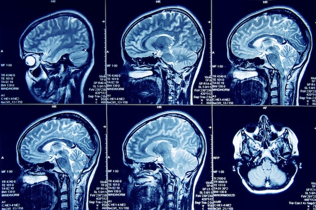 imaging a risonanza magnetica del cervello umano nel piano sagittale.