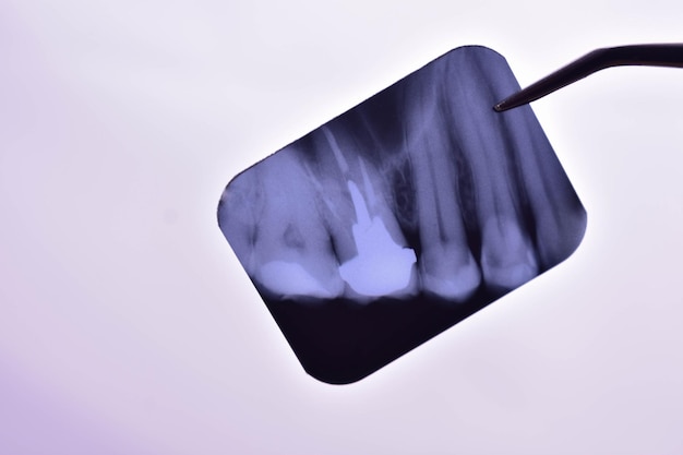 Immagine a raggi X dei denti nelle mani di un medico
